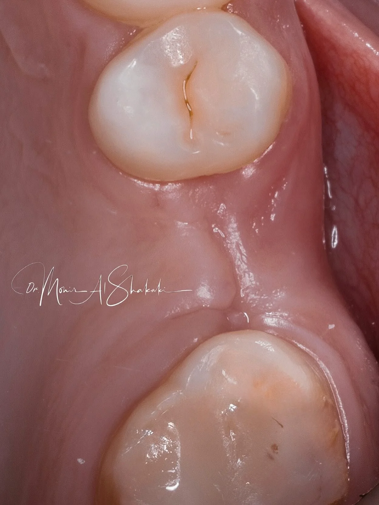 Single implant with restoration over it🌱 #implants