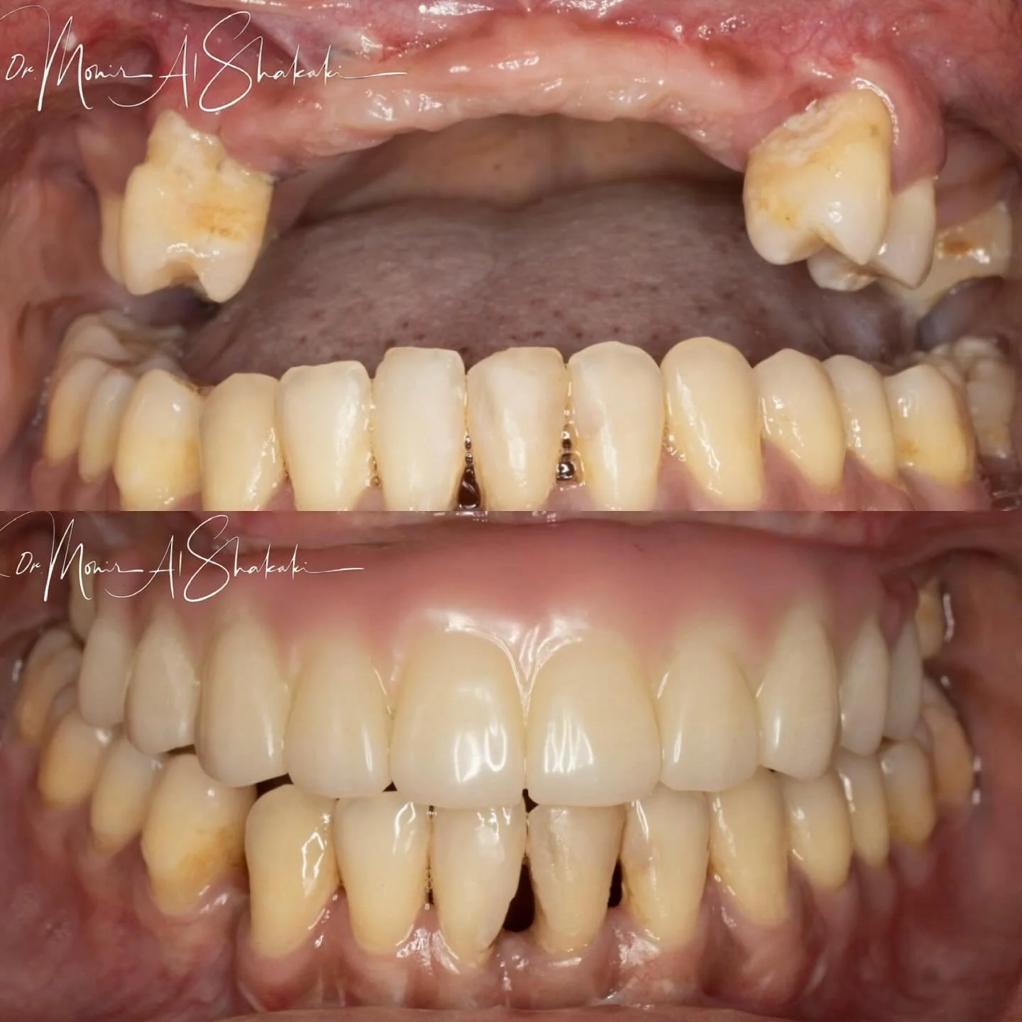 Bringing back her smile 😊👍🏼 

Four dental implants restoring life to this patient.

#dental #dental_clinic #smile
