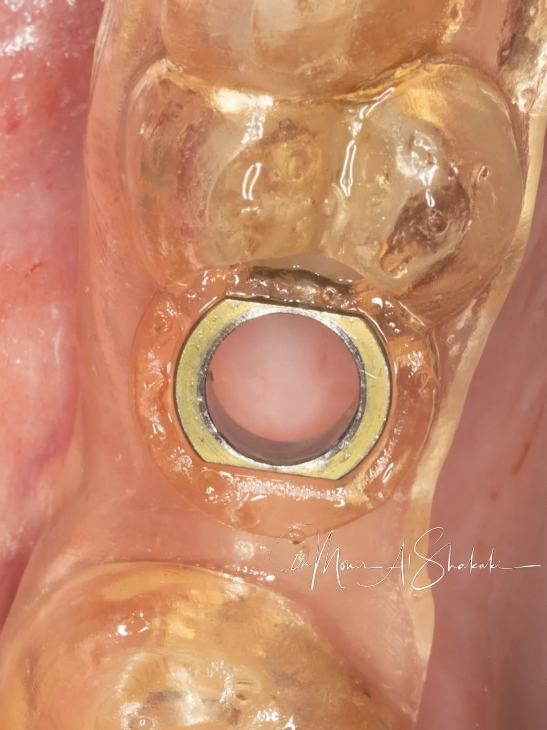 Flapless Implant Placement with Surgical Guide 
يعتبر من أدق وأحدث التقنيات في زراعة الأسنان
هي الطريقة بتقلّل النزف، وبيخفّف الألم بعد العملية، ووبيسرّع الشفاء، ووذمة شبه معدومة بالاضافة لأنها بتعطيني دقة عالية
هي تقنية  بتسمح بإدخال الزرعة مباشرة  