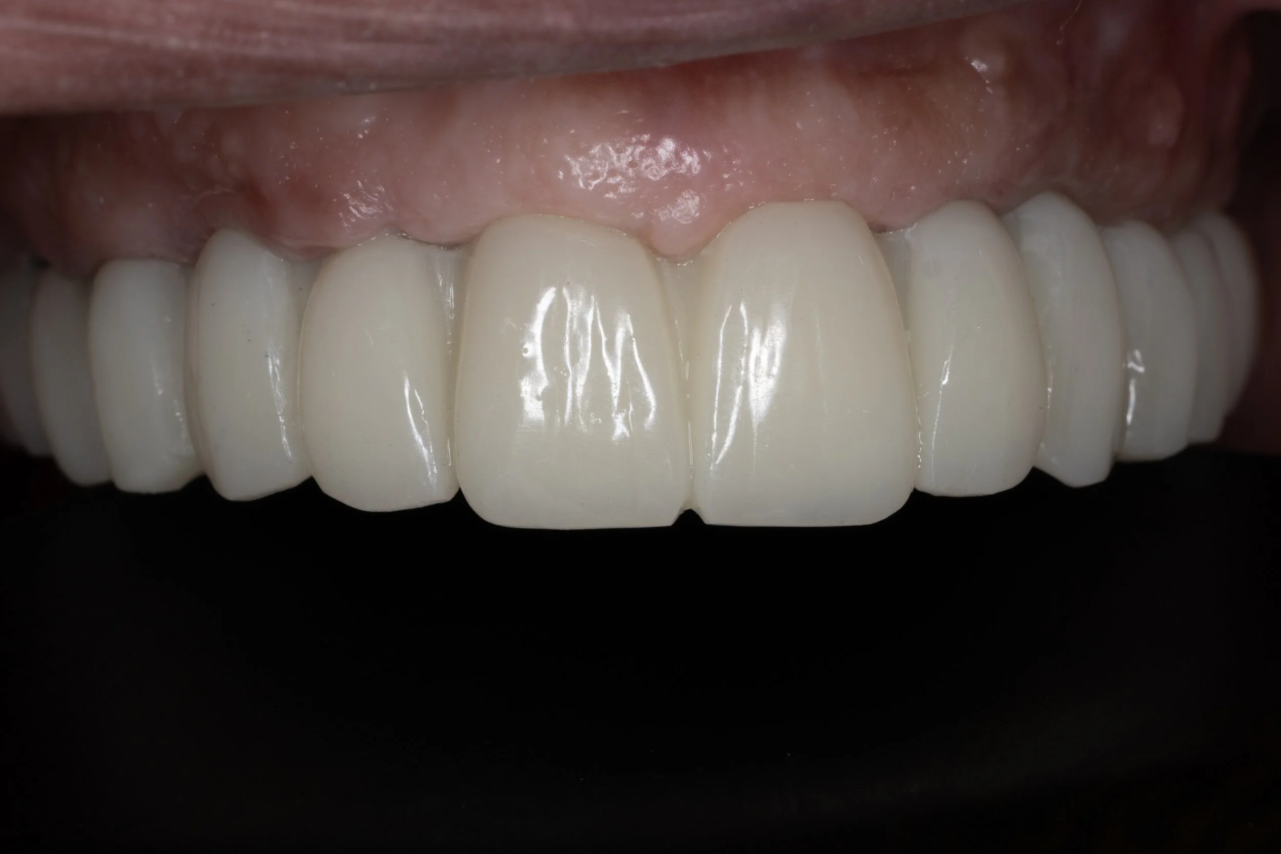 Good planning for complicated case like the one in the picture, will make the result looks excellent and the process will be easy for the doctor and for the patient as well. 

in this case Full Mouth Rehabilitation was needed, and using the newest te