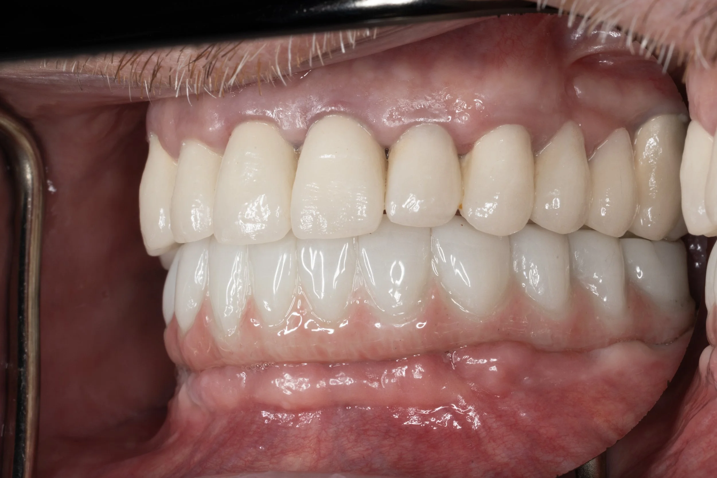 Full Arch Rehabilitation