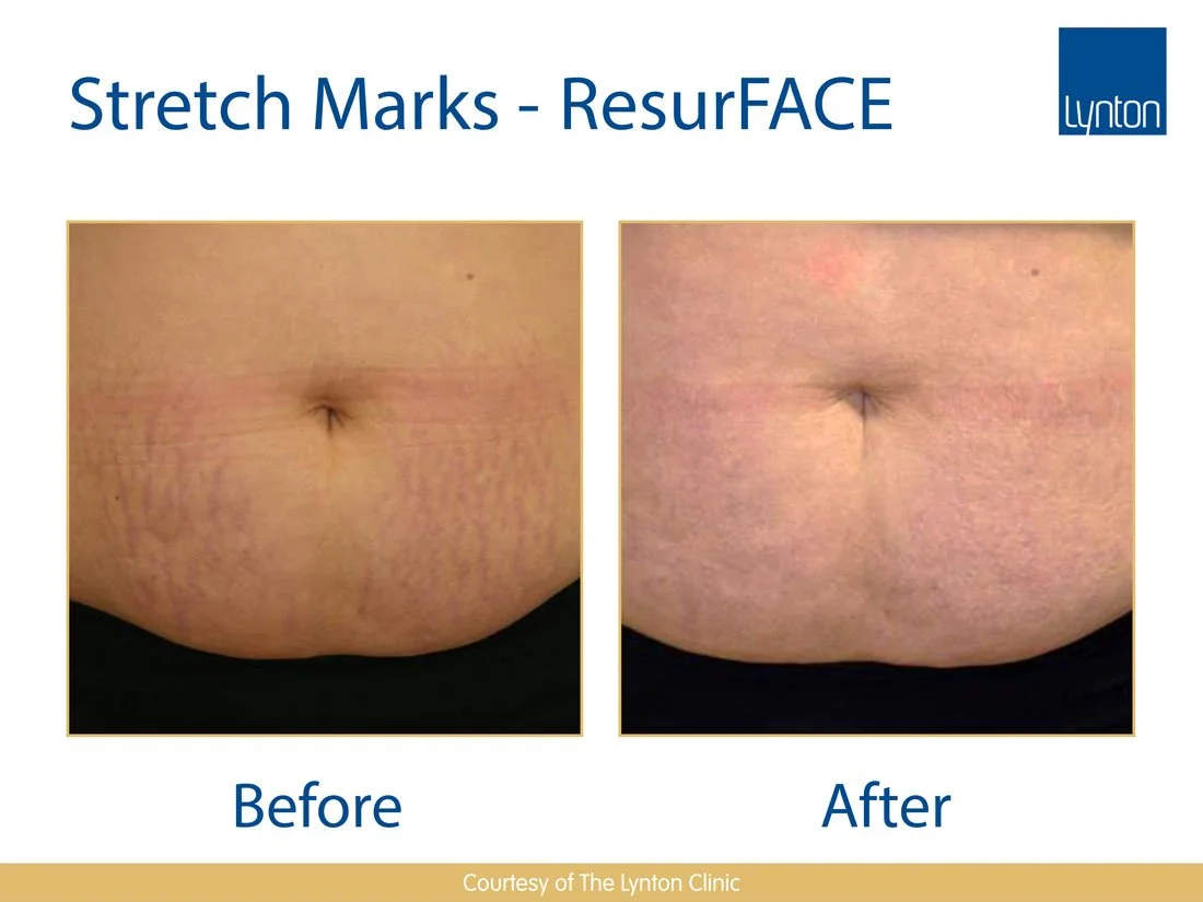 Comparison of stomach skin showing stretch marks before and after treatment, with the before image on the left and the after image on the right.