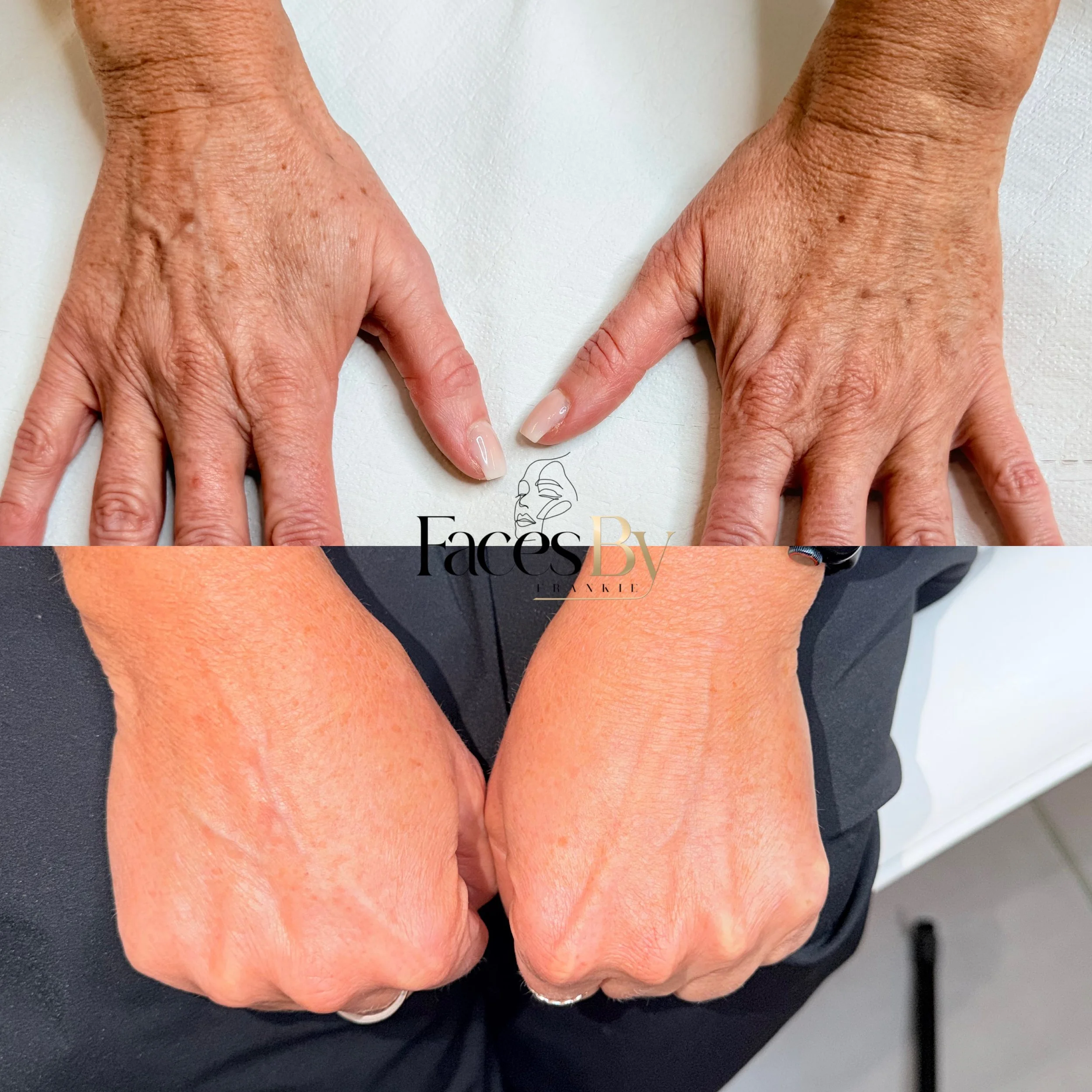 Close-up of two hands with wrinkled skin, pointing downwards on a white surface with a black fabric underneath.