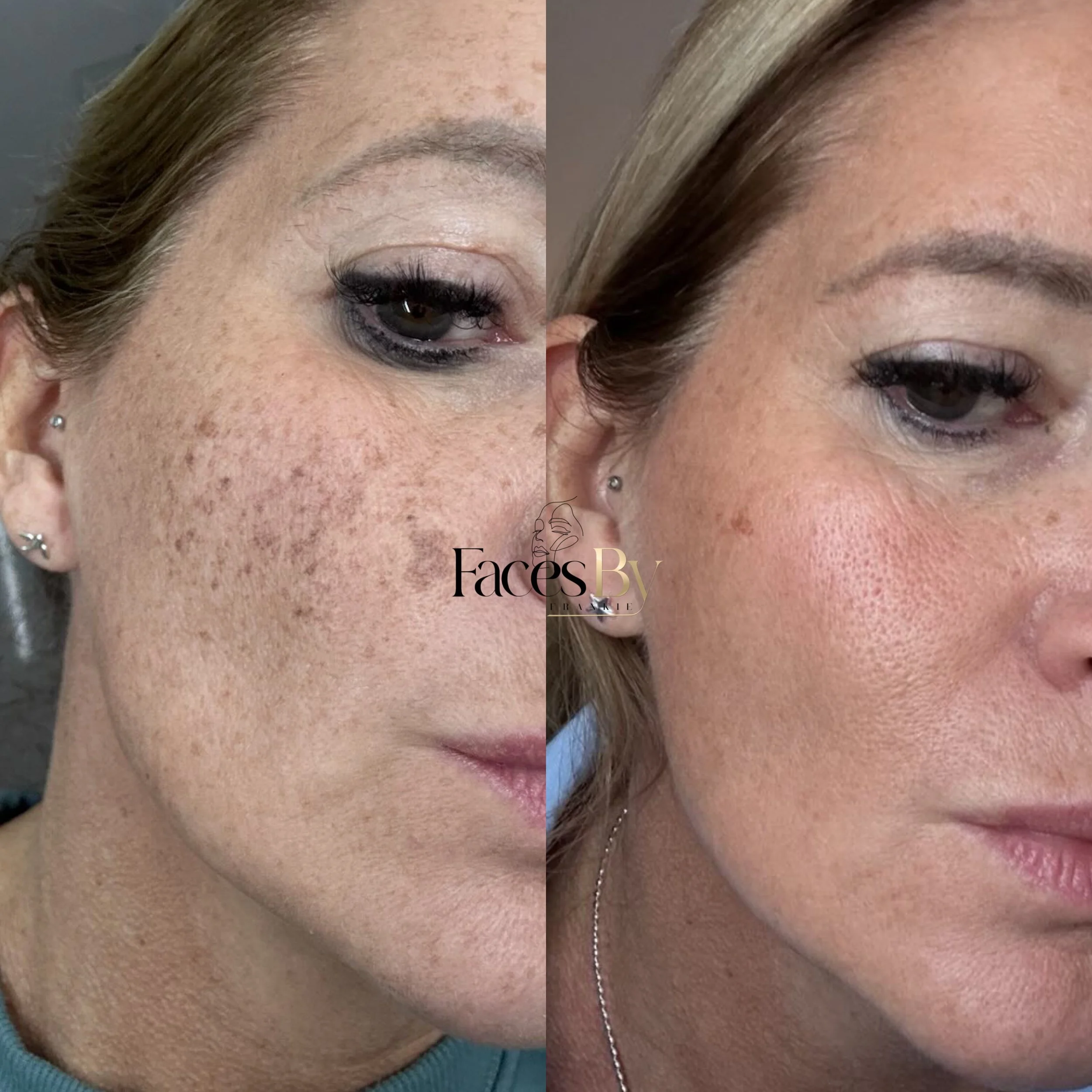 Side-by-side close-up images of a woman's face showing before and after skin treatment, with improved skin texture and reduced pigmentation in the after photo.