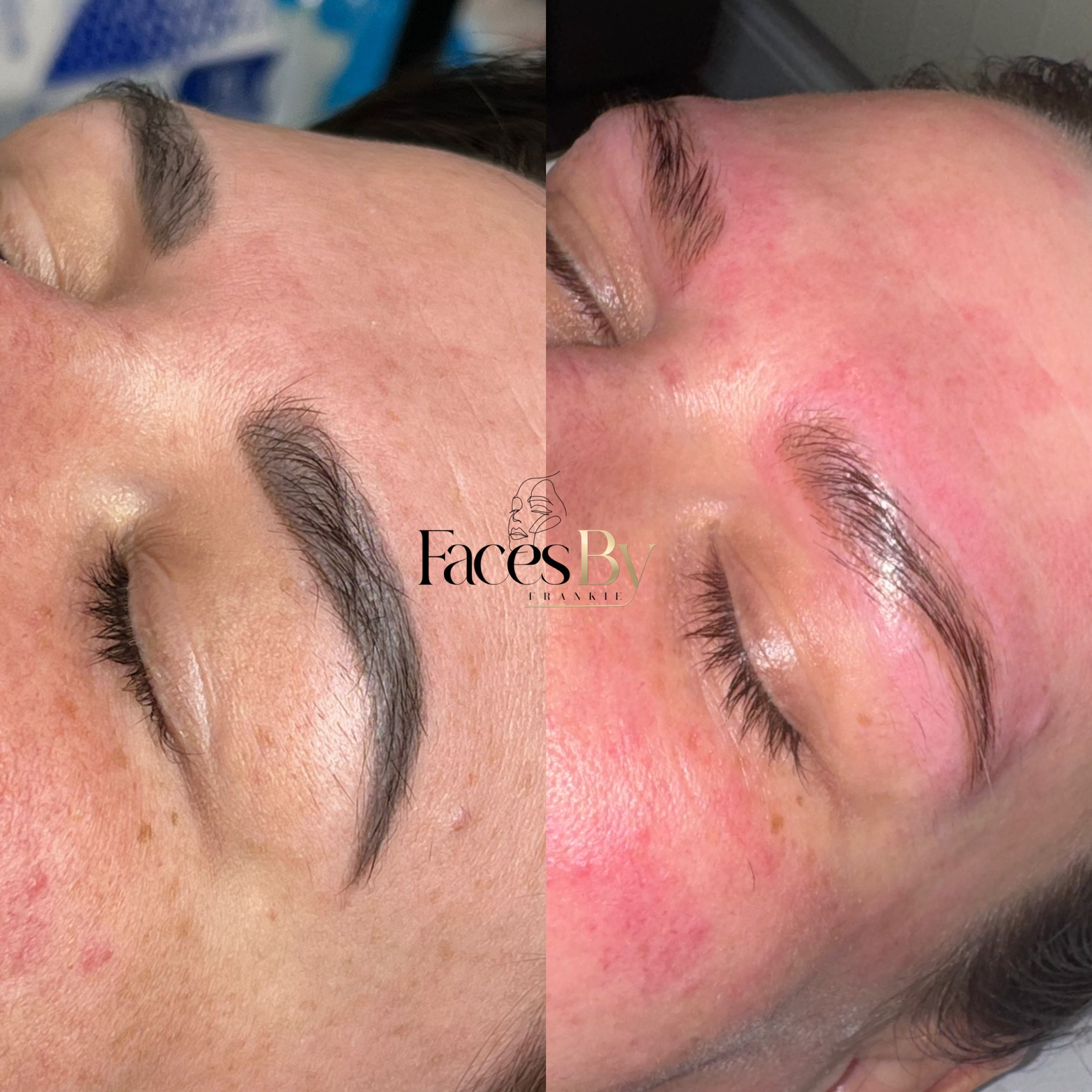 Close-up of a person's forehead and eyebrows, showing before and after cosmetic treatment, with the skin appearing smoother and more even in the after section.