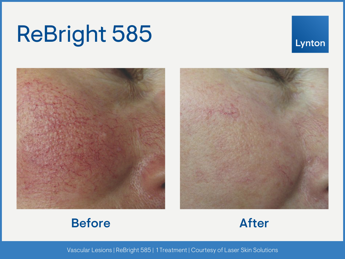 Comparison of facial skin showing reduction in redness and visible blood vessels after a treatment, with before and after images side by side.