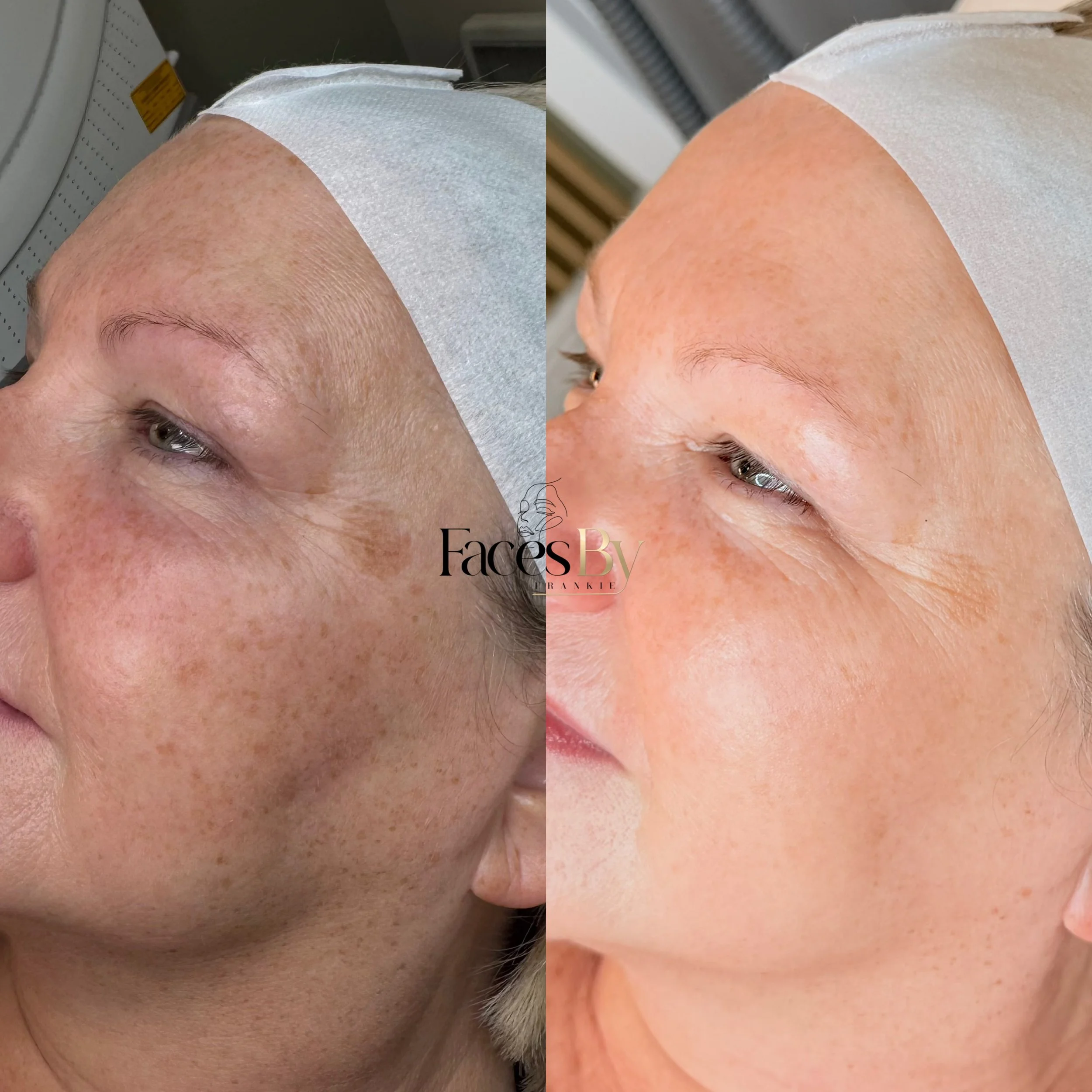 Close-up of a person's forehead and eyes before and after skincare treatment, showing improved skin texture and appearance.