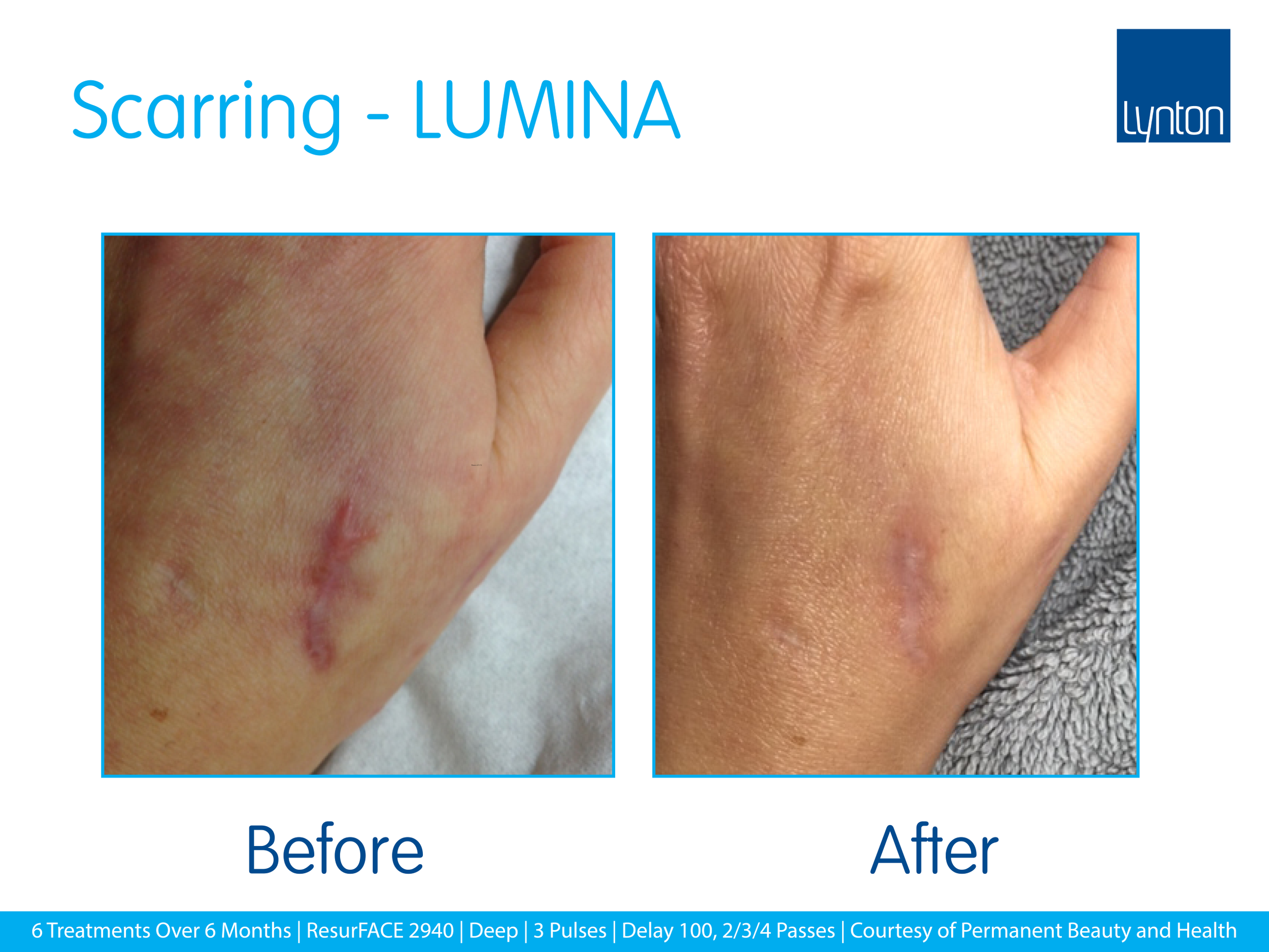 Comparative before and after images of a person's skin showing reduced scarring after treatment.