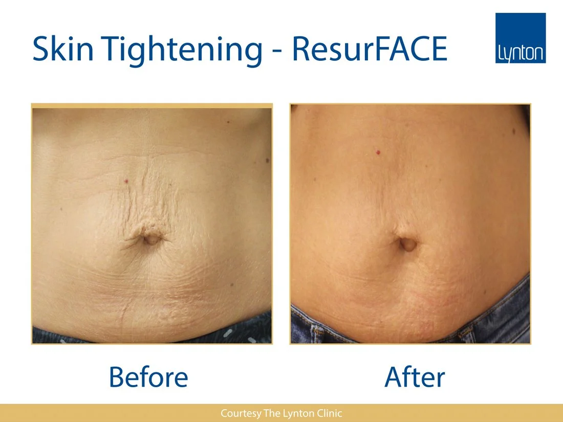 Close-up comparison of a person's belly with before and after skin tightening treatment showing reduced wrinkles and firmer skin.