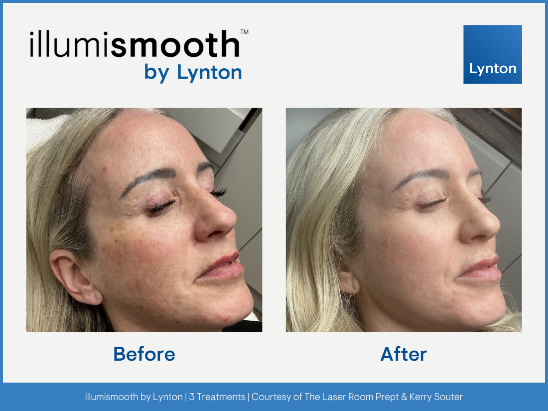 Side-by-side comparison of a woman's face before and after skincare treatment showing clearer skin with reduced blemishes and discoloration.