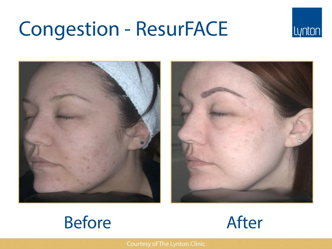 Side-by-side comparison of a woman's face showing reduction in facial congestion and acne scars, with 'Before' on the left and 'After' on the right, as part of a skin treatment advertisement.