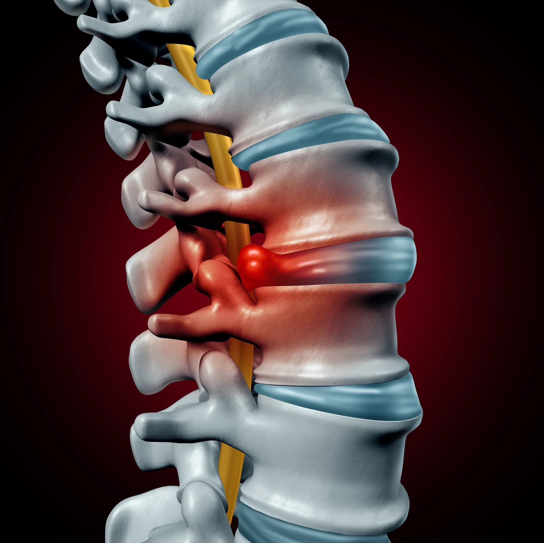 A detailed medical illustration of the human spine showing vertebrae, intervertebral discs, spinal cord, and nerve roots, with color-coded sections for clarity.