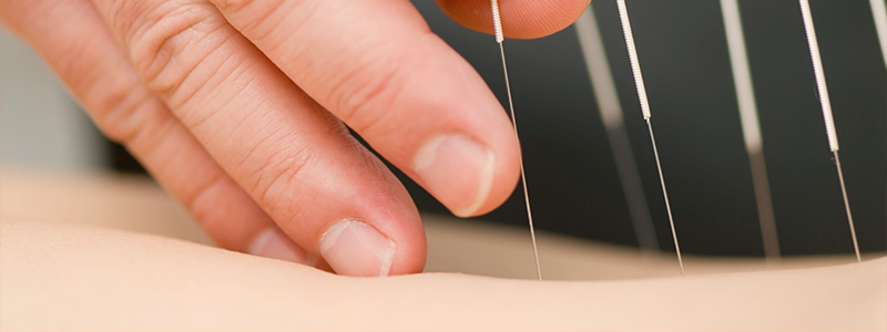 Close-up of a hand inserting acupuncture needles into a person's back.
