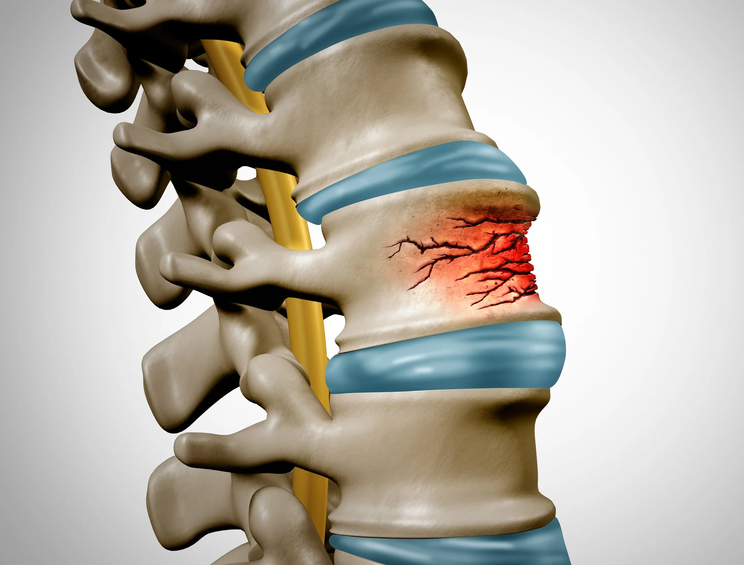 A detailed 3D illustration of a human lumbar spine, highlighting a herniated disc with cracks and inflammation at the lower part of the lumbar vertebrae.