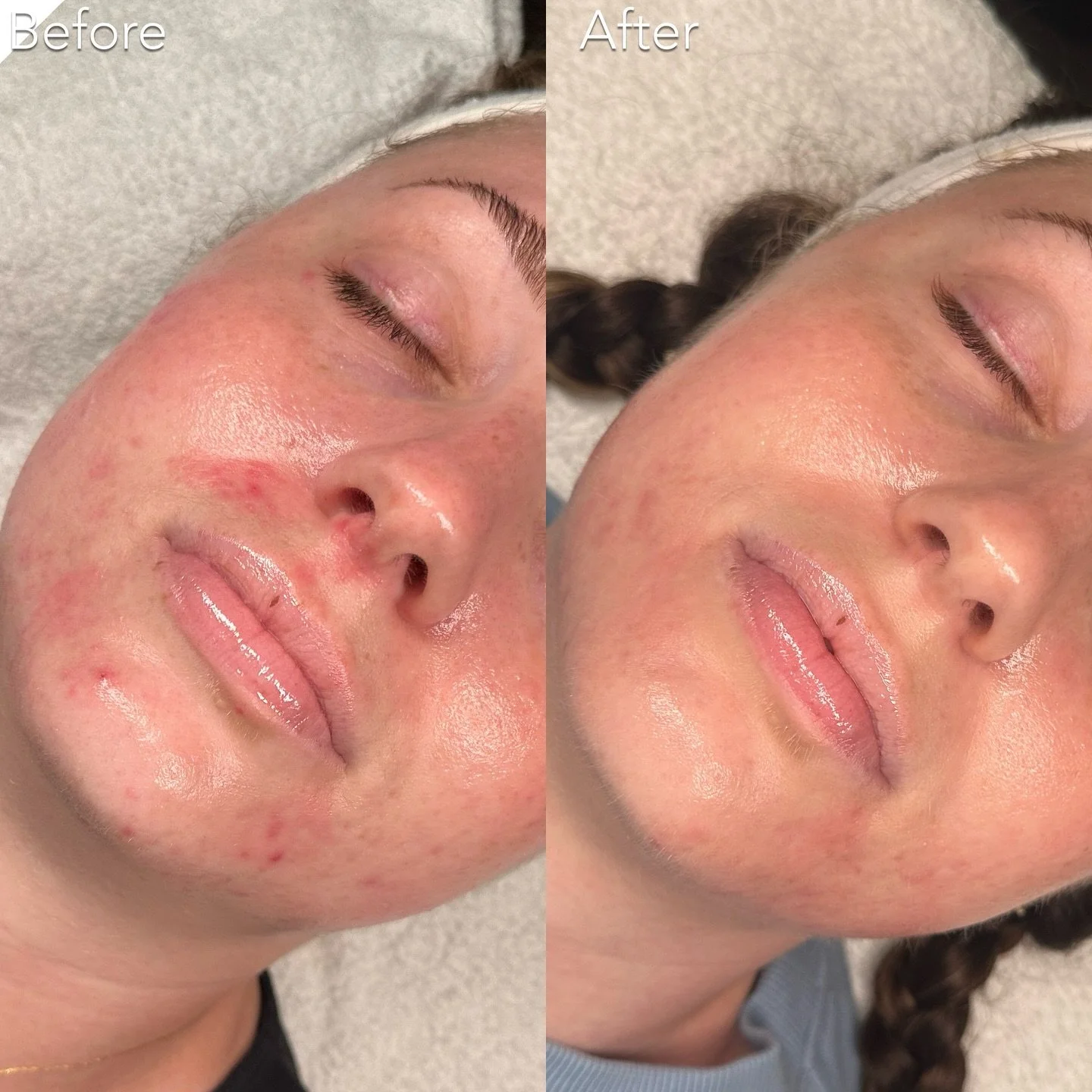 Healthy barrier = clear skin! 

Less can be more. Repair first, calm the skin, and then clear the acne. A healthy barrier is the foundation of clear skin ✨