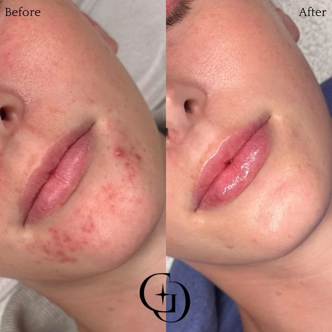 Acne and post-inflammatory erythema: when you&rsquo;re mostly clear, but it never quite feels that way. Breakouts come and go, and they leave behind red marks that still look like active pimples. Staying clear is only part of the work. Consistency is