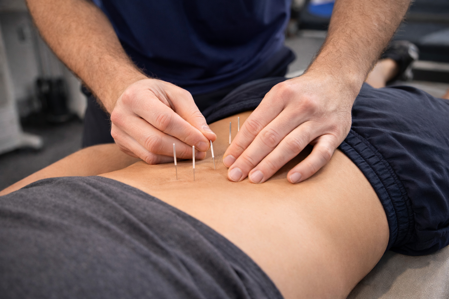 Dry Needling