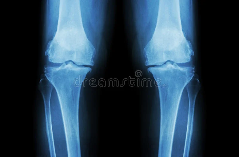 Osteoarthritis - Facts, Myths, Symptoms 