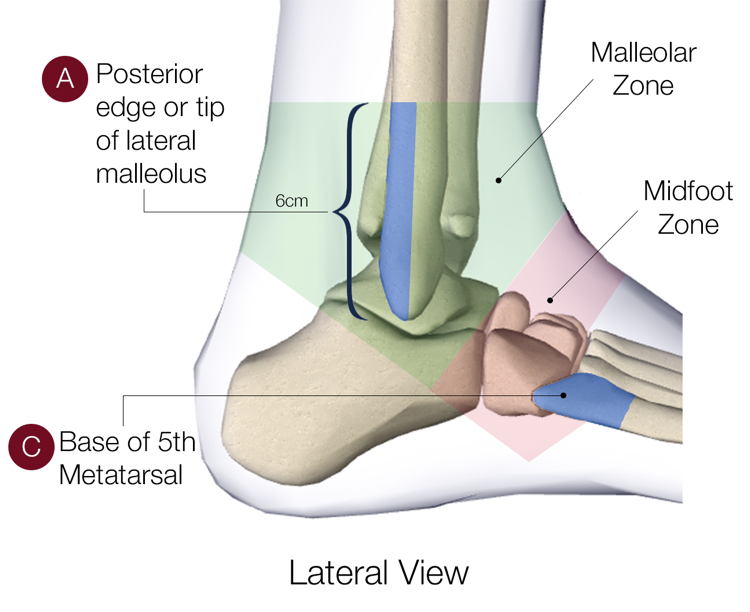 Figure 1: Showing lateral view of ankle including points of bony tendernessRetrieved from http://www.theottawarules.ca/ankle_rules