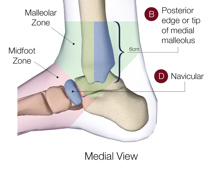 Figure 2: Showing medial view of ankle including points of bony tendernessRetrieved from http://www.theottawarules.ca/ankle_rules
