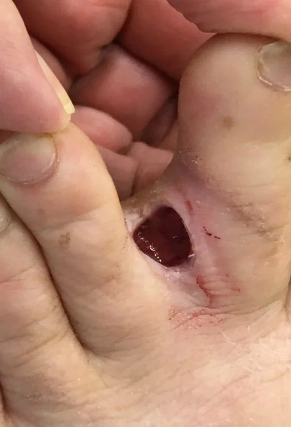Two toes spread apart to show a hollow bloody/ red space.