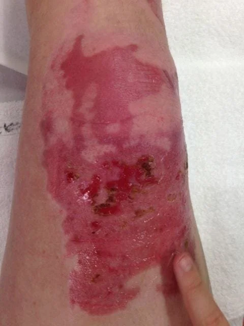 Huge red boody and blotchy bleeding skin over and around the knee