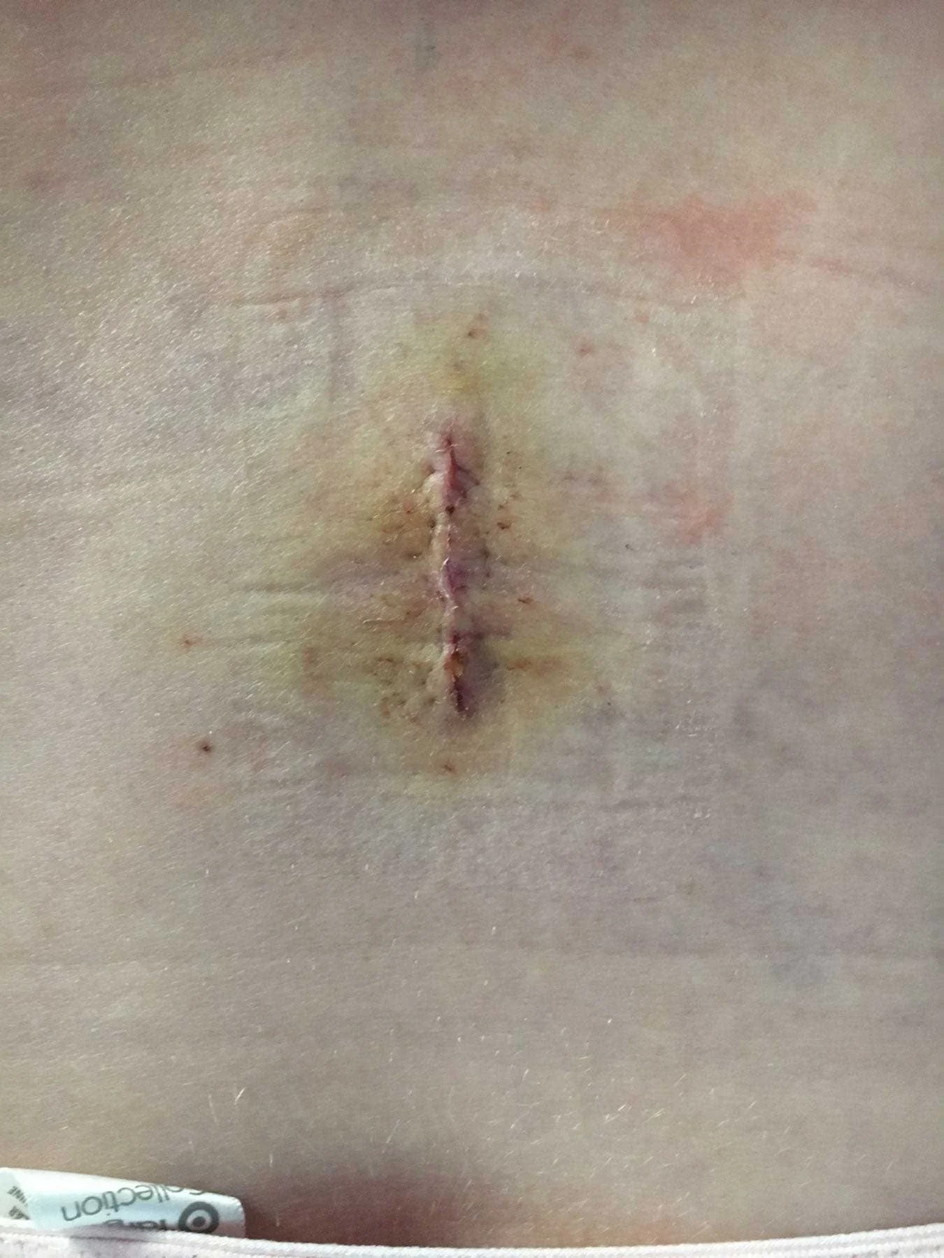 Close up image of a purple and red scar