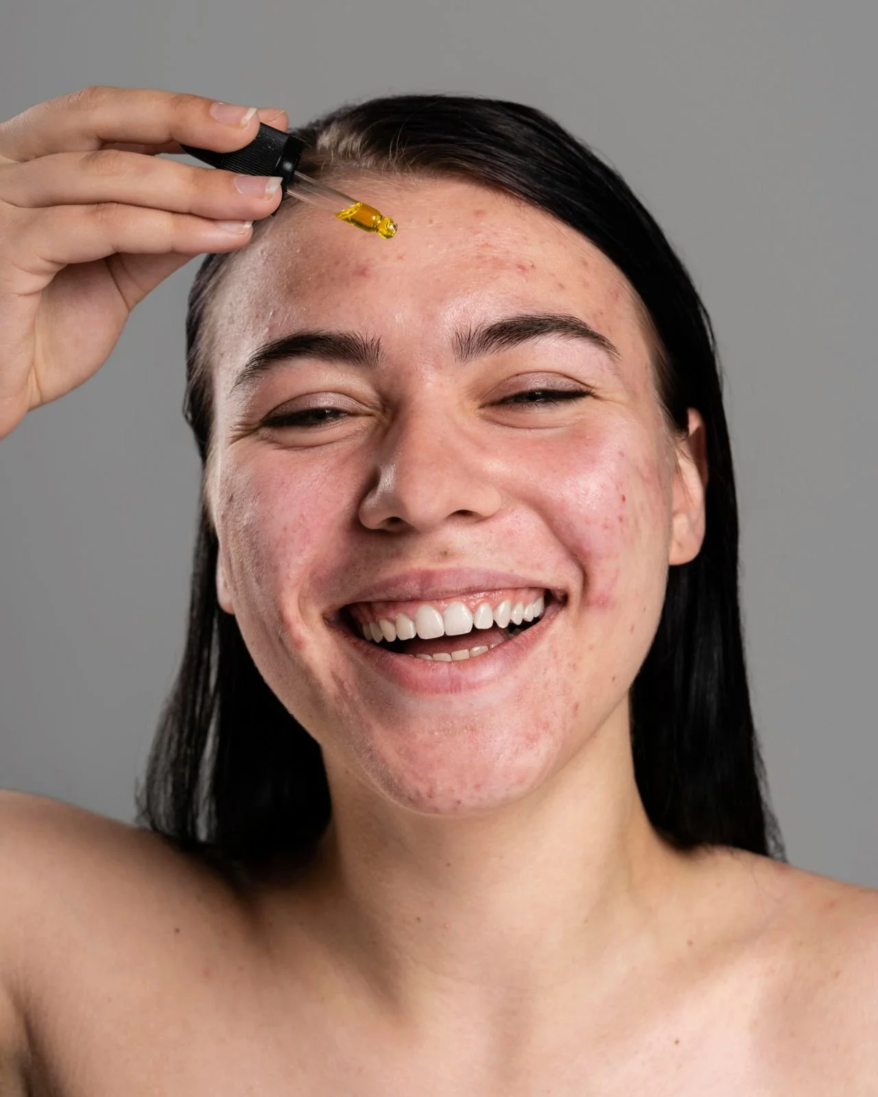 A woman with acne, smiling, holding a dropper filled with yellow oil toward her forehead.