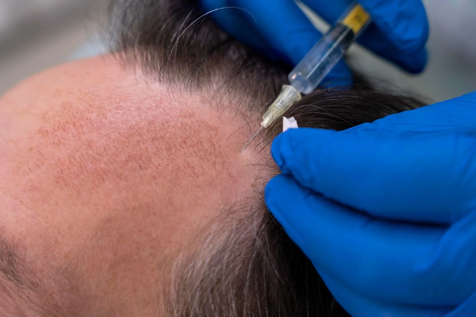 Close-up of a person receiving a scalp injection in a medical setting, with hands wearing blue gloves holding a syringe.”}