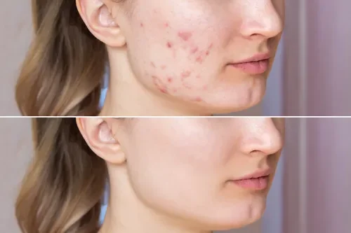 Close-up of a woman's face showing clear skin after acne treatment, with visible improvement from the before to after images.