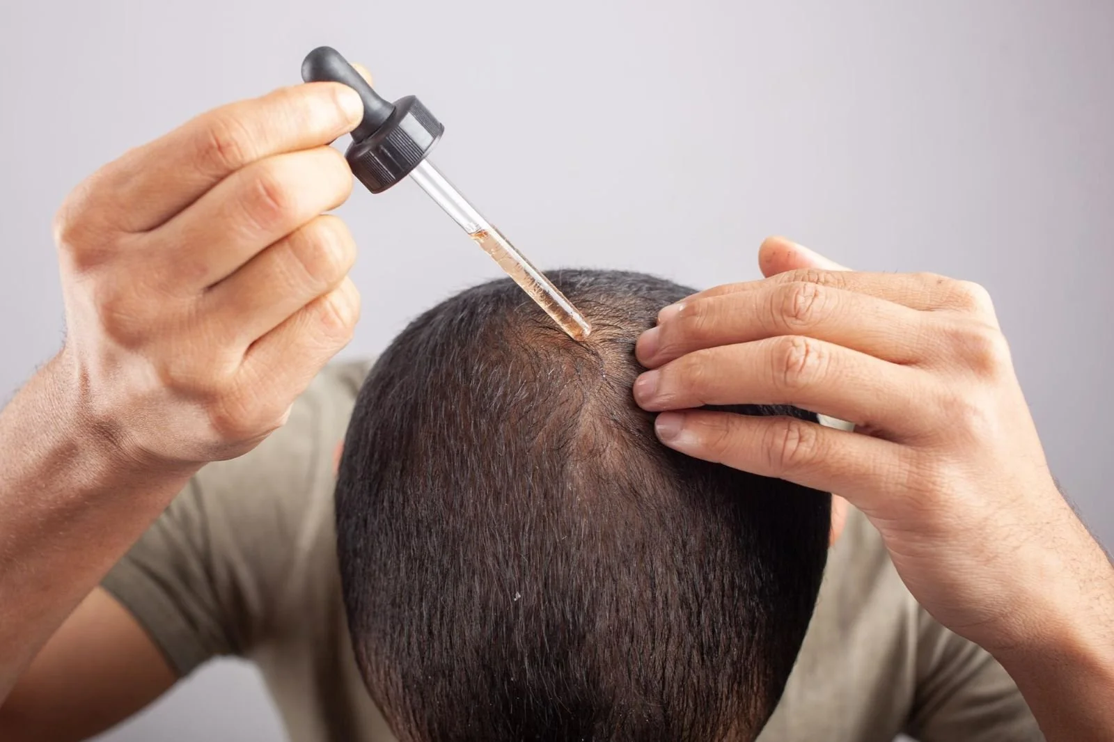 Person administering a hair transplant with a syringe on their scalp.