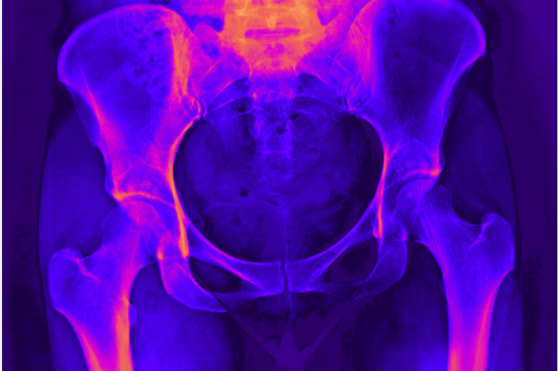 Pelvic Floor Physiotherapy: The Missing Piece in Pelvic Pain? 