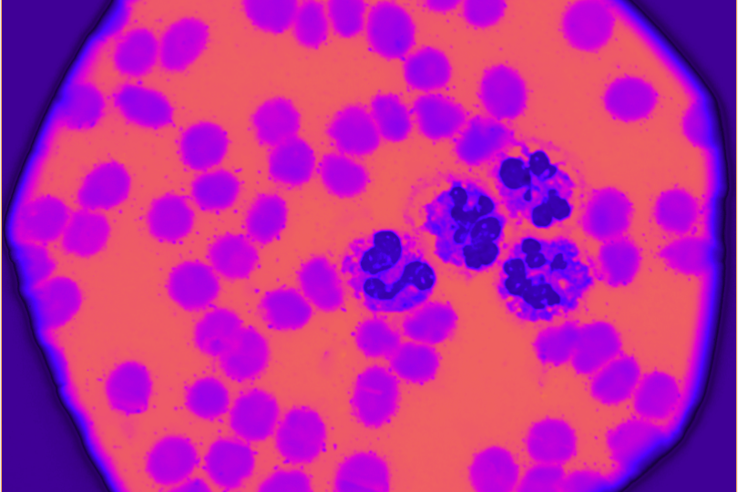 Could We Be the First Generation to Eliminate Cervical Cancer?