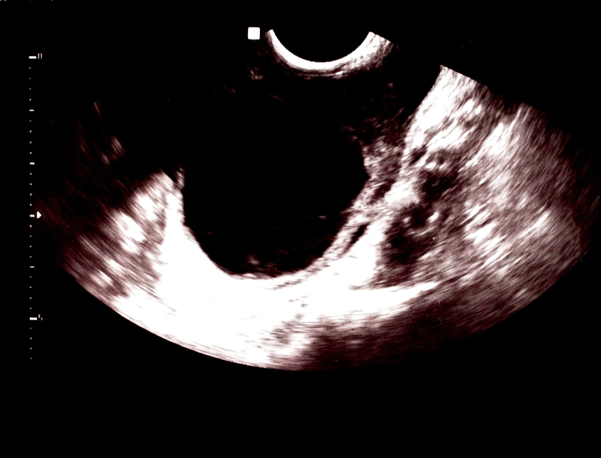 Ultrasound image of a developing fetus in the womb.