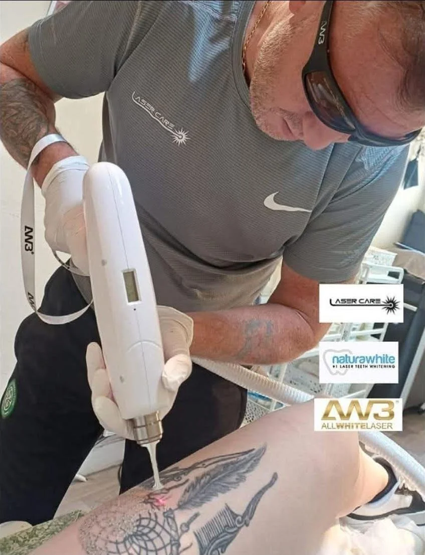A man wearing sunglasses and a gray athletic shirt is performing laser tattoo removal on a person's tattooed leg using a laser device. The tattoo features a feather, a syringe, and a globe. The room appears to be a medical or tattoo removal clinic.