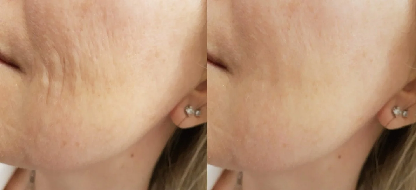 Redermalizzazione: cos'è, come funziona e perché è diversa da tutti gli altri trattamenti. 