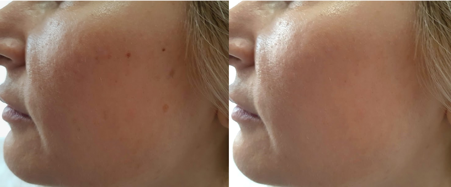 Caso clinico: Peeling chimico TCA combinato con biorivitalizzazione:  uniformazione del colorito e rigenerazione cutanea.