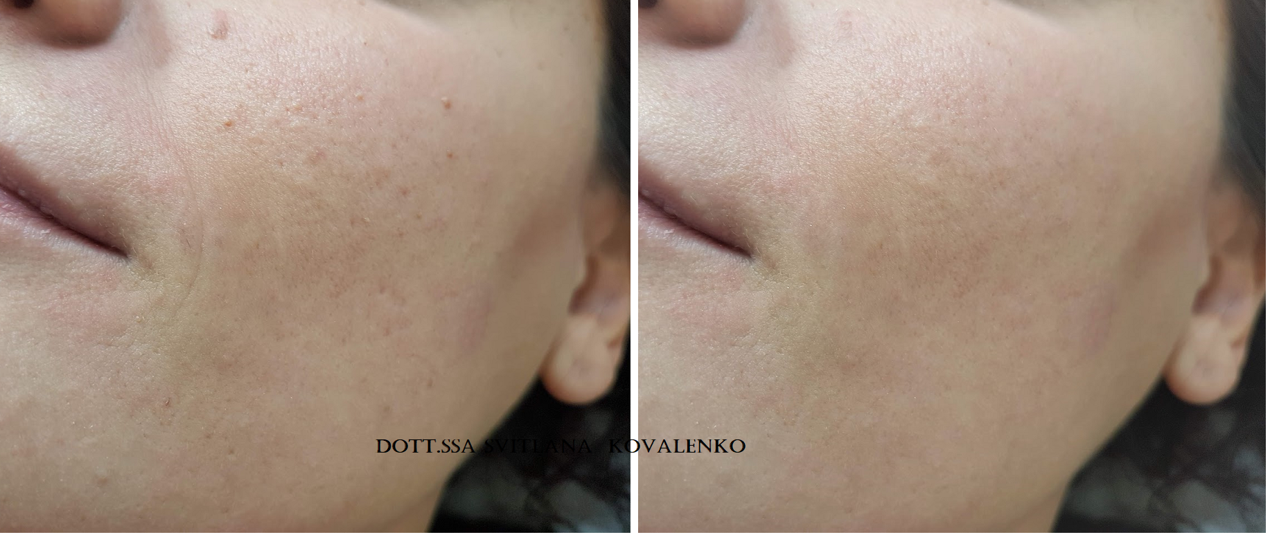 Risultati redermalizzazione prima e dopo: miglioramento della texture cutanea, riduzione delle discromie e delle lesioni acneiche. Trattamento eseguito dalla Dott.ssa Svitlana Kovalenko, medico estetico a Roma.