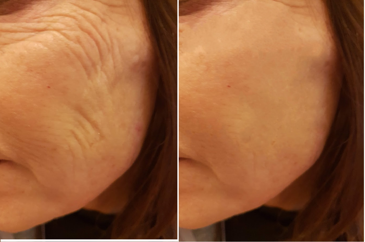 Caso clinico. Trattamento biostimolante su paziente di 68 anni.  Riduzione delle rughe profonde attraverso la rigenerazione  del collagene endogeno — senza iniezioni di volume © Dott.ssa Svitlana Kovalenko