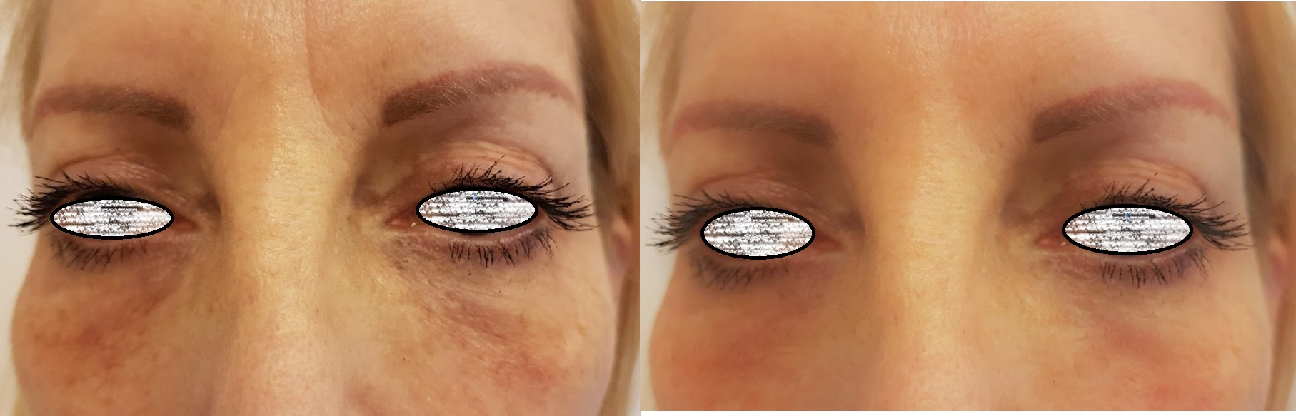 Redermalizzazione perioculare prima e dopo: trattamento occhiaie pigmentarie e puffiness, risultato visibile dopo 3 sedute — Dott.ssa Svitlana Kovalenko, Roma