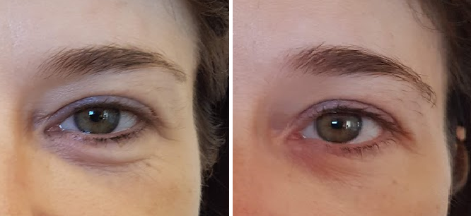 Redermalizzazione perioculare prima e dopo: riduzione occhiaie vascolari, trattamento contorno occhi Roma — Dott.ssa Svitlana Kovalenko