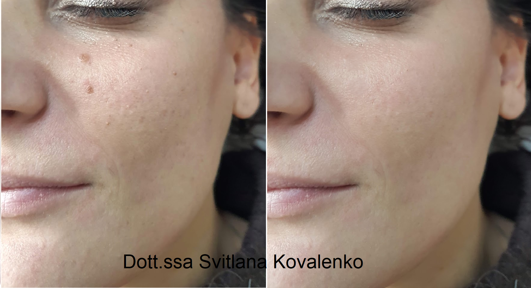 Caso clinico: biorivitalizzazione con PDRN.  Miglioramento visibile di texture, pori e luminosità.  © Dott.ssa Svitlana Kovalenko