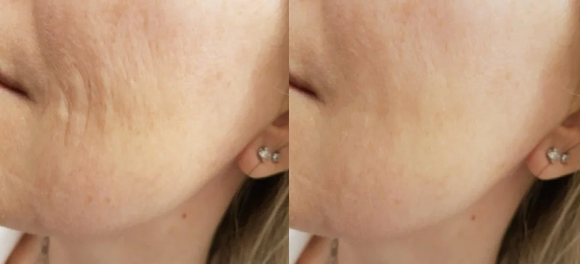 Redermalizzazione con Xelarederm 2,2% prima e dopo: riduzione delle rughe fini e miglioramento della texture cutanea su guancia e zigomo. Trattamento eseguito dalla Dott.ssa Svitlana Kovalenko, medico estetico a Roma.