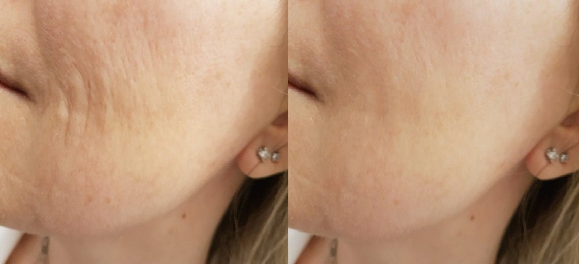 Redermalizzazione prima e dopo — Dott.ssa Svitlana Kovalenko