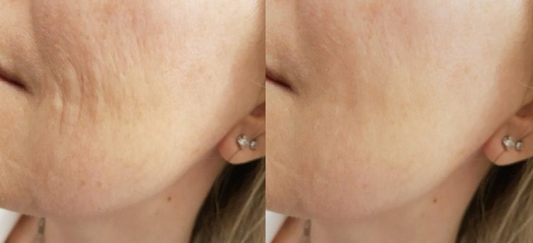 Redermalizzazione Roma risultati Xelarederm Dott.ssa Kovalenko