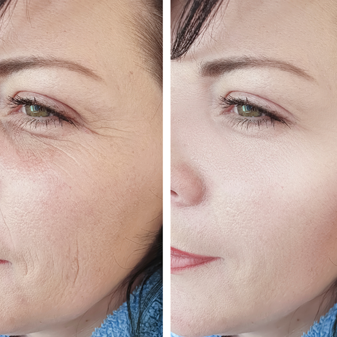 Medicina estetica preventiva filler viso Roma - Dott.ssa Kovalenko
