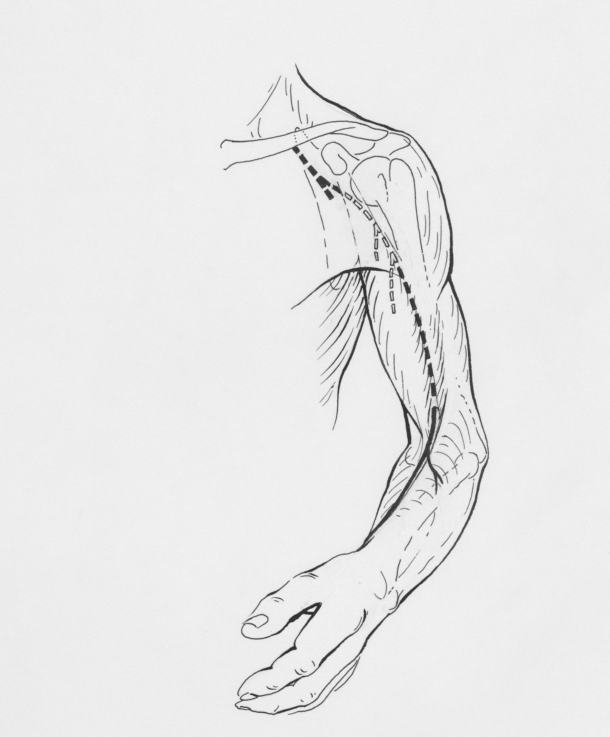Line drawing of a human shoulder, arm, and hand highlighting shoulder surgery or shoulder pain area.