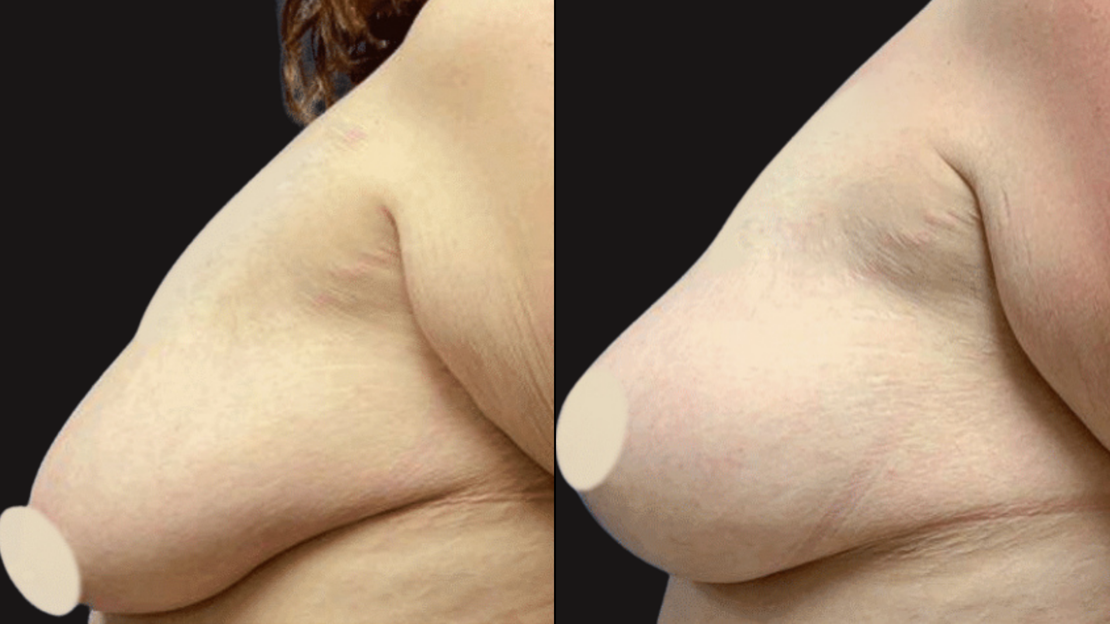 Close-up of a person's shoulder and upper arm from different angles, with a black background.