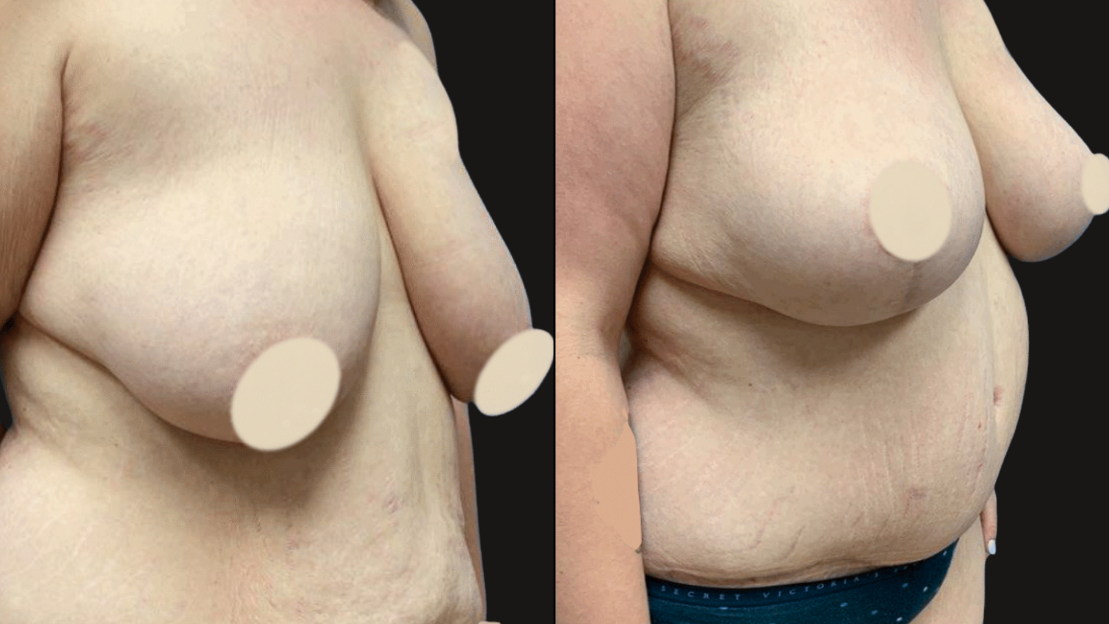 Comparison of a person's upper body with and without breast augmentation, showing before and after results.