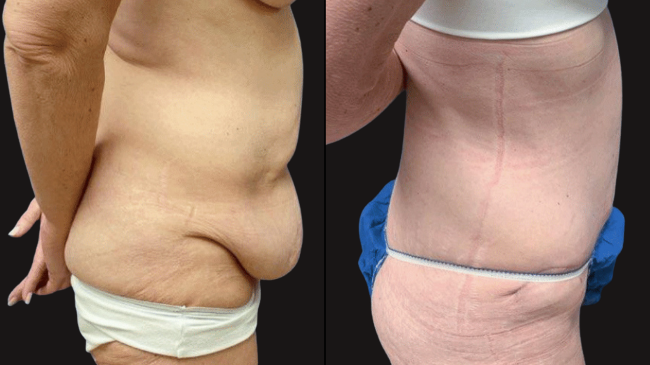 Side-by-side comparison of a person's torso before and after surgery, showing significant reduction in abdominal size and excess skin, with visible surgical scars on the after photo.